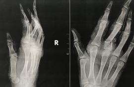 Medicii IMSP IMU i-au replantat cu succes degetul de la mână unei paciente de doar 11 ani
